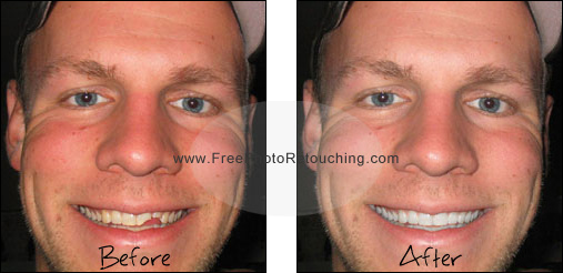 Fix chipped teeth with retouching